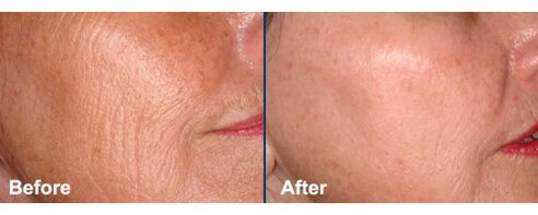 Facial skin before and after laser rejuvenation