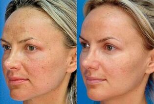 Photo before and after skin rejuvenation with the device